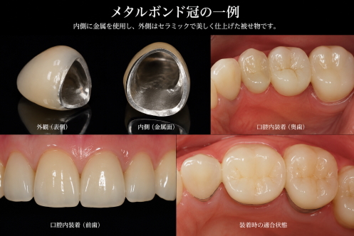 メタルボンド冠の前歯及び臼歯の例示写真。